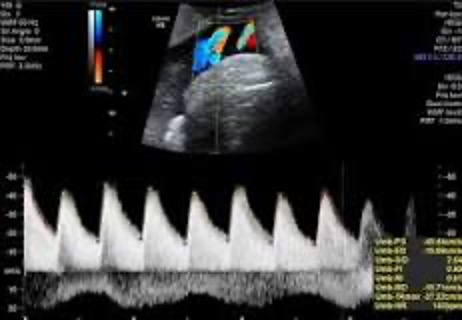 Growth Scan & Doppler